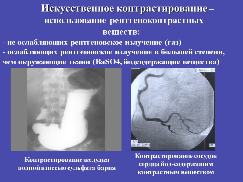 Искусственное контрастирование –      использование рентгеноконтрастных веществ: - не ослабляющих